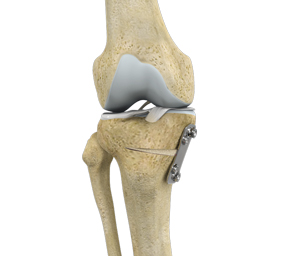Proximal Tibial Osteotomy
