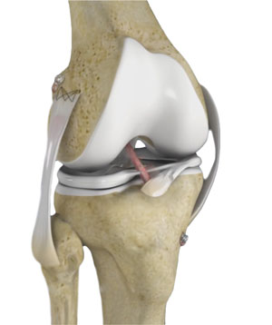 Multiligament Reconstruction of the Knee